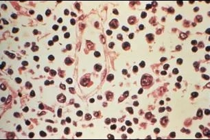 hantavirus